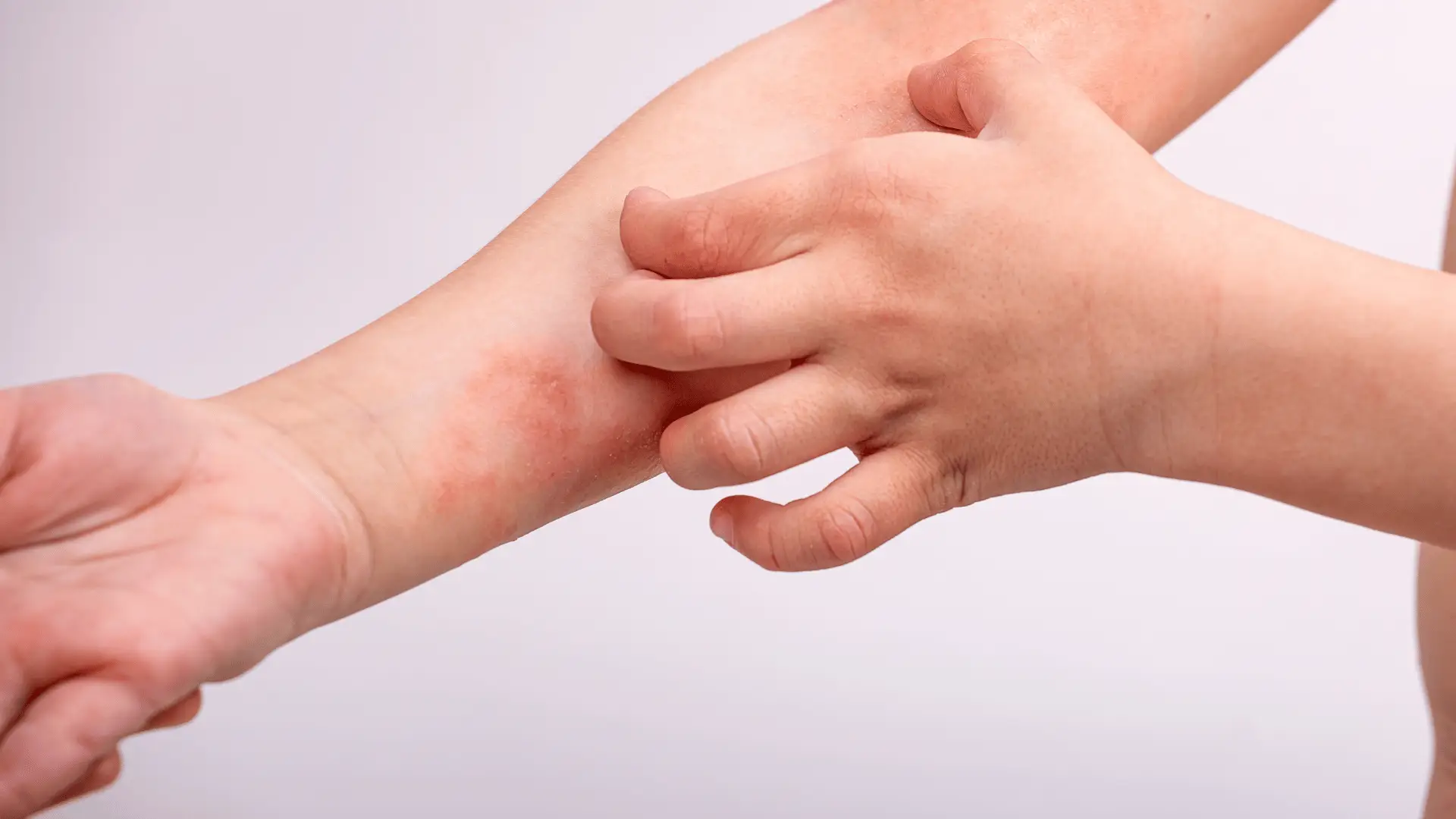 Physician examining eczema during a clinical trial consultation