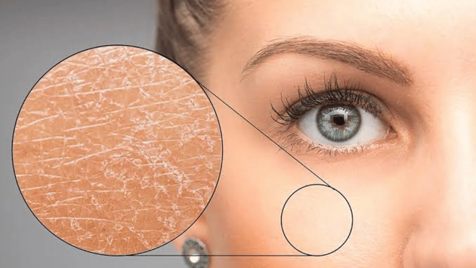 Sjogren's disease